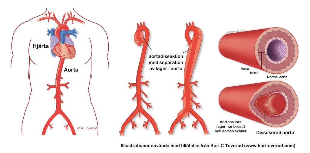 kari c toverud aortadissektion